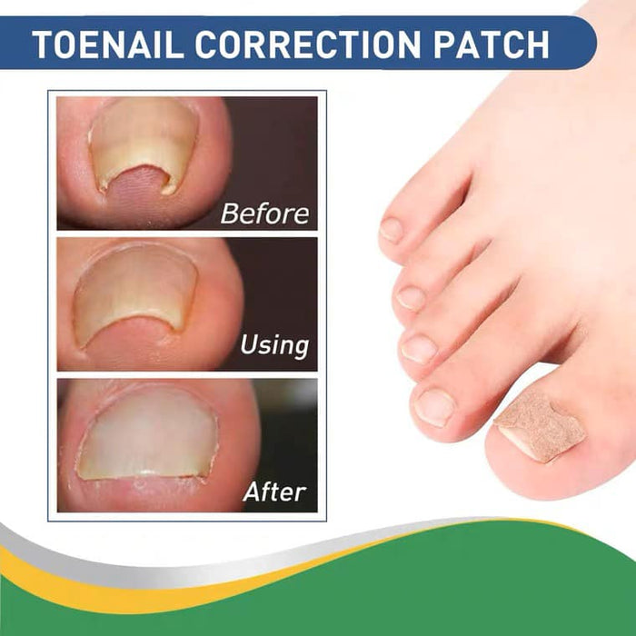 Toe Nail Correction Patch