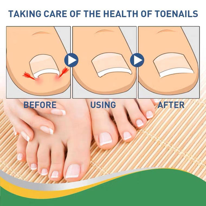 Toe Nail Correction Patch